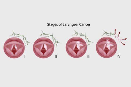 stage 4 throat cancer prognosis.